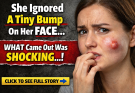 She Ignored a Tiny Bump on Her Face… Until It Became Something She Couldn’t Hide Anymore